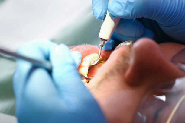 Best Emergency Treatment for Dental Infections or Abscesses in Camp Swift, TX